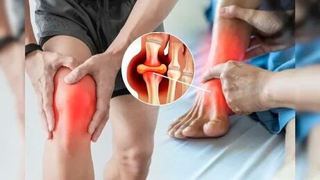 Oblasti pokožky vhodné pro aplikaci gelu Icexin (kolena, lokty, spodní část zad)