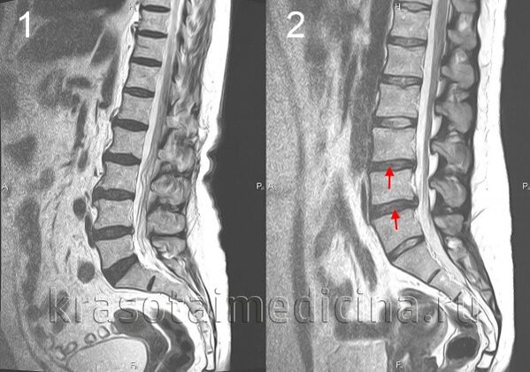 spinální osteochondróza
